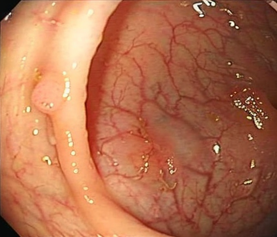 Synthetic polyp