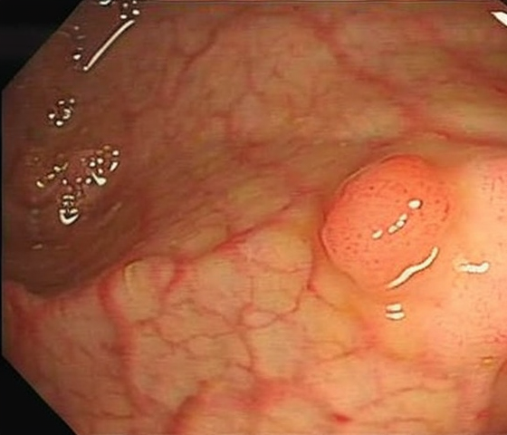 Synthetic polyp