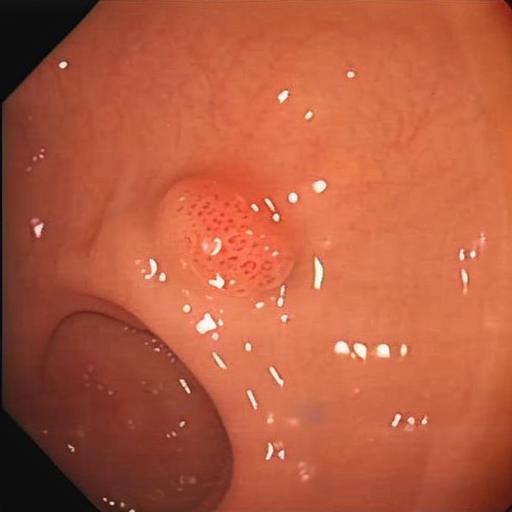 Synthetic polyp