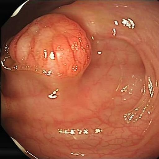 Synthetic polyp