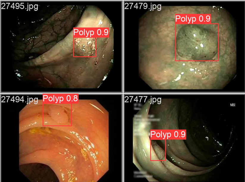 Identified polyp