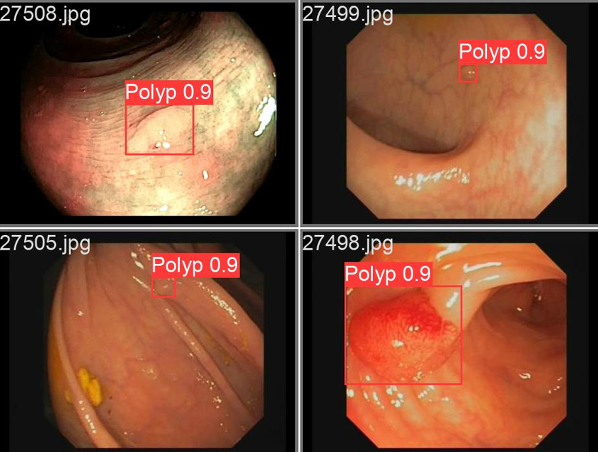 Identified polyp