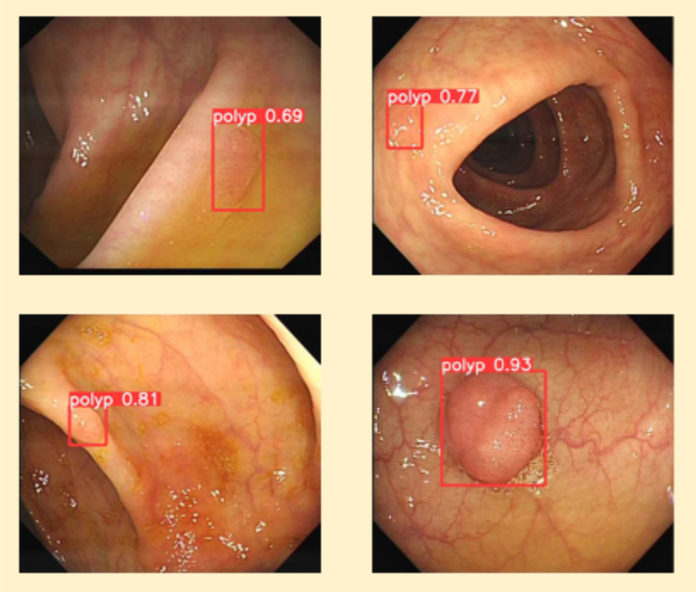 Identified polyps